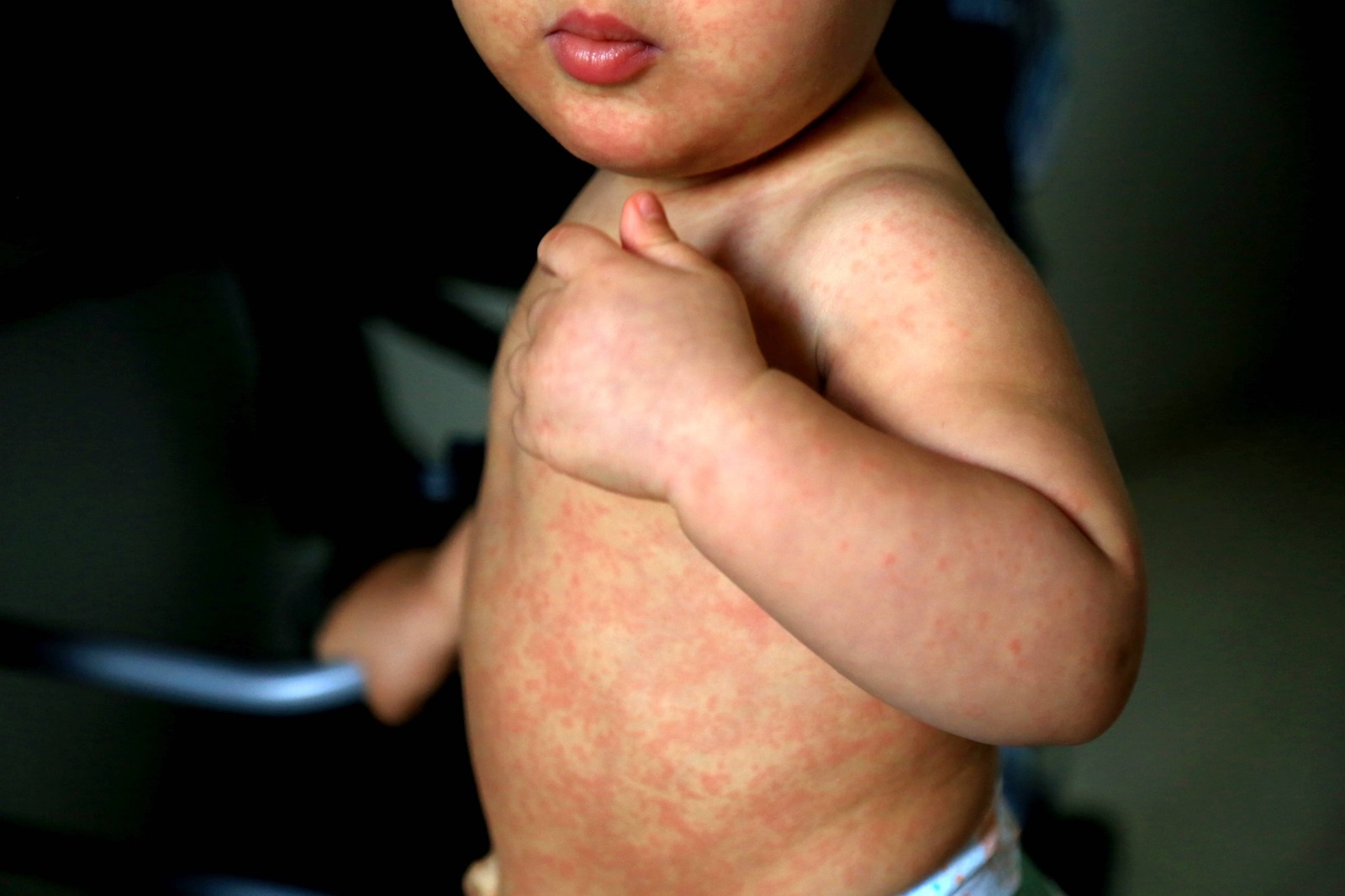 child with measles symptoms salvador, bahia / brazil - february 14, 2017: Child with measles symptoms is seen with small red spots on body and feverish state. *** Local Caption *** . SALVADOR BAHIA BRASIL Copyright: xJoaxSouzax 220117JOA05Z,Image: 803183975, License: Rights-managed, Restrictions: imago is entitled to issue a simple usage license at the time of provision. Personality and trademark rights as well as copyright laws regarding art-works shown must be observed. Commercial use at your own risk., Credit images as "Profimedia/ IMAGO", Model Release: no, Credit line: Joa Souza / imago stock&people / Profimedia