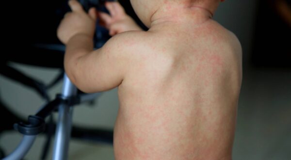 child with measles symptoms salvador, bahia / brazil - february 14, 2017: Child with measles symptoms is seen with small red spots on body and feverish state. *** Local Caption *** . SALVADOR BAHIA BRASIL Copyright: xJoaxSouzax 220117JOA04Z,Image: 803183970, License: Rights-managed, Restrictions: imago is entitled to issue a simple usage license at the time of provision. Personality and trademark rights as well as copyright laws regarding art-works shown must be observed. Commercial use at your own risk., Credit images as "Profimedia/ IMAGO", Model Release: no, Credit line: Joa Souza / imago stock&people / Profimedia