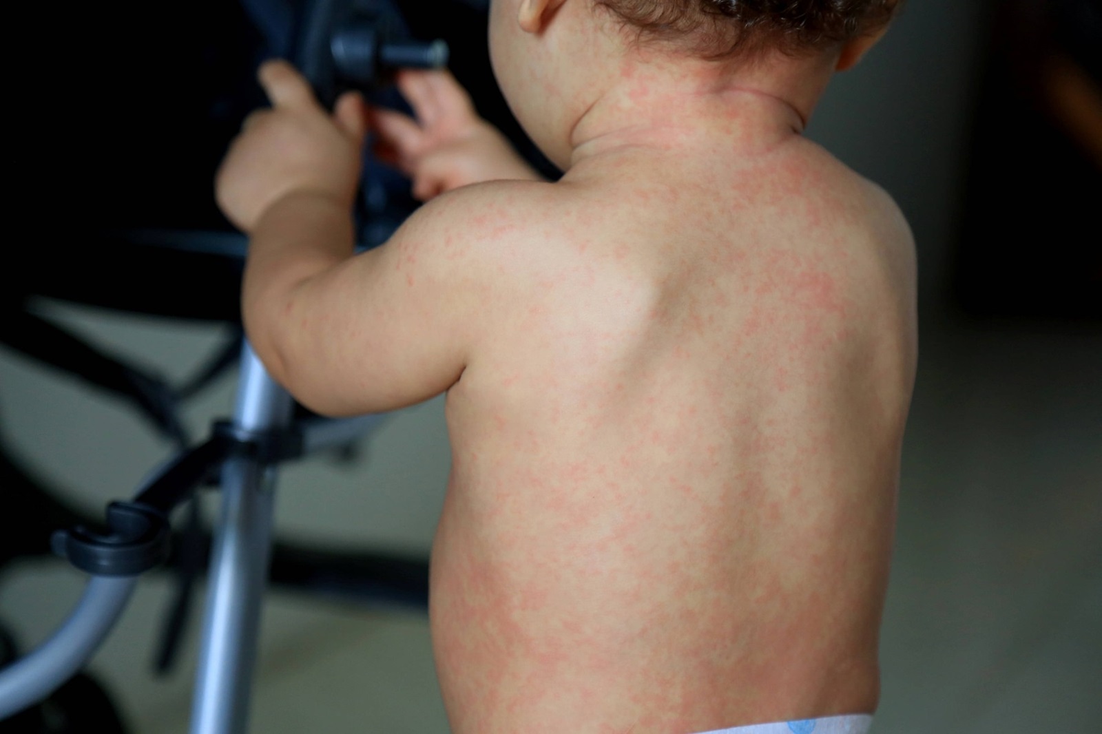 child with measles symptoms salvador, bahia / brazil - february 14, 2017: Child with measles symptoms is seen with small red spots on body and feverish state. *** Local Caption *** . SALVADOR BAHIA BRASIL Copyright: xJoaxSouzax 220117JOA04Z,Image: 803183970, License: Rights-managed, Restrictions: imago is entitled to issue a simple usage license at the time of provision. Personality and trademark rights as well as copyright laws regarding art-works shown must be observed. Commercial use at your own risk., Credit images as "Profimedia/ IMAGO", Model Release: no, Credit line: Joa Souza / imago stock&people / Profimedia